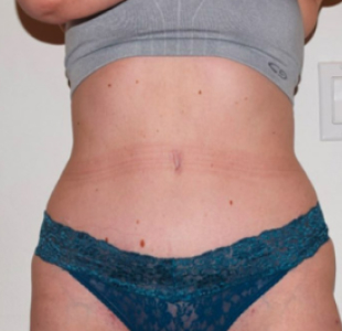 Tummy Tuck After Result New York City & Manhattan