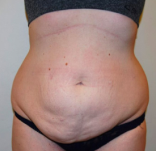 Tummy Tuck Before Result New York City & Manhattan