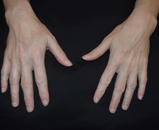 Aquagold Before Result New York City