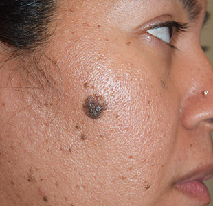 Mole Removal Before Result New York City