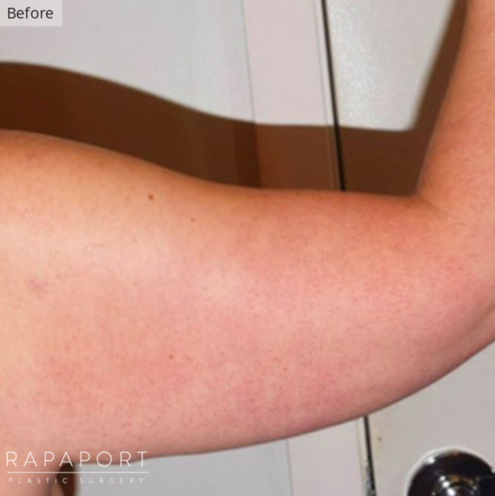 woman in new york cit holing up arm before getting arm liposuction