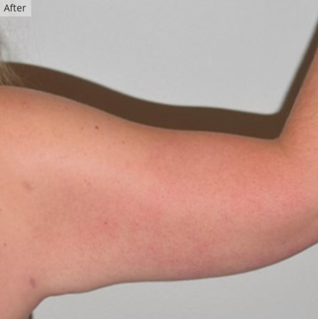 woman in new york cit holing up arm after getting arm liposuction