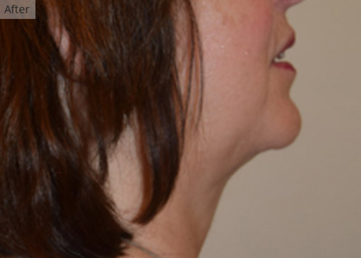 woman before undergoing neck liposuction in Manhattan
