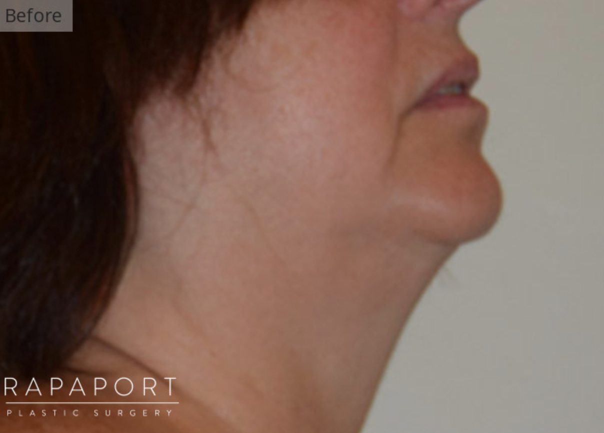 woman before undergoing neck liposuction in Manhattan