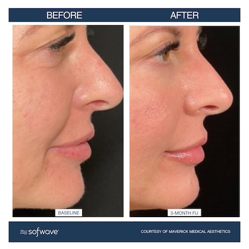 Photo shows a middle-aged woman side profile of her face before and after Sofwave treatment