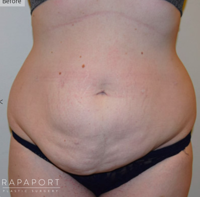 images of what happens to the abdomen after pregnancy.