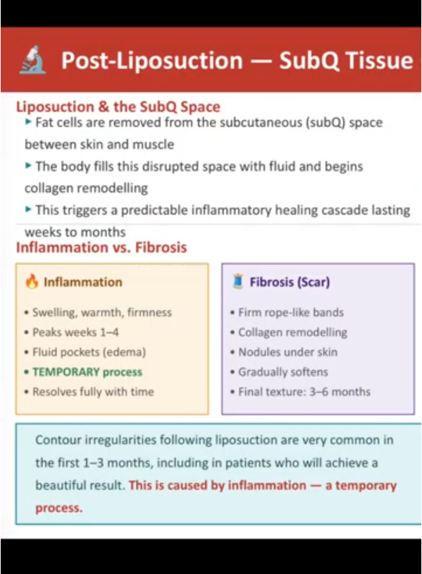 Post liposuction and inflammation vs fibrosis